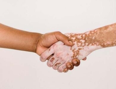 Indian-Subcontinent-Has-Worlds-Highest-Rate-Of-Vitiligo India West